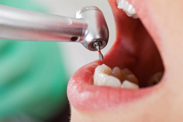 Best Emergency Root Canal Treatment in Buckhead Ridge, FL